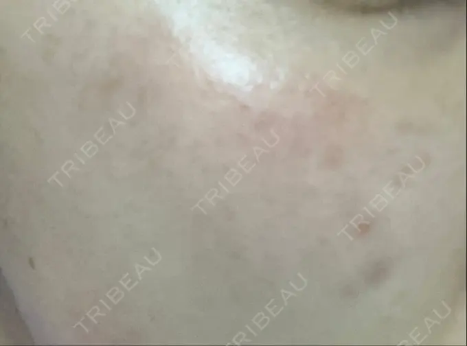 ピコレーザートーニング（美白・肝斑） / ピコスポット HAAB BEAUTY CLINIC 横浜院 DAY 17 メイン用