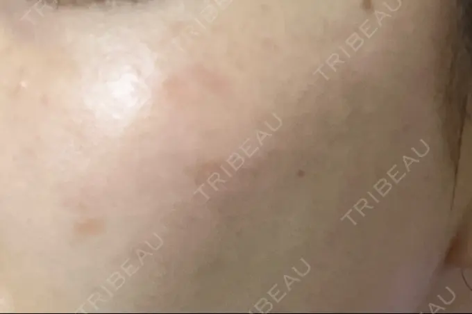 ピコレーザートーニング（美白・肝斑） / ピコスポット HAAB BEAUTY CLINIC 横浜院 DAY 17 メイン用