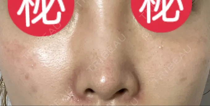 ピコレーザートーニング（美白・肝斑） / ピコスポット HAAB BEAUTY CLINIC 横浜院 AFTER メイン用