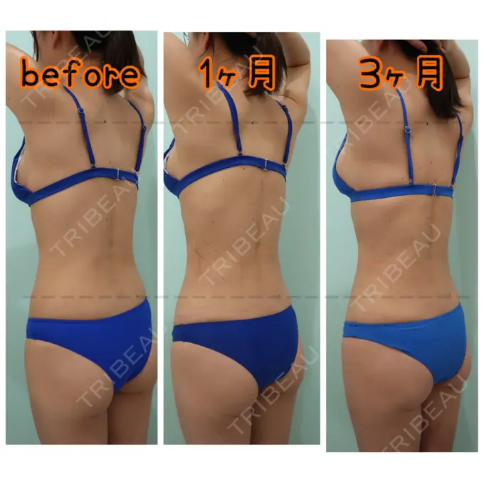 糸リフト / 脂肪吸引（顔） / 脂肪吸引（お腹） / 脂肪吸引（腰） / 脂肪吸引（背中） WOM CLINIC GINZA （ワム クリニック ギンザ） DAY 100 メイン用