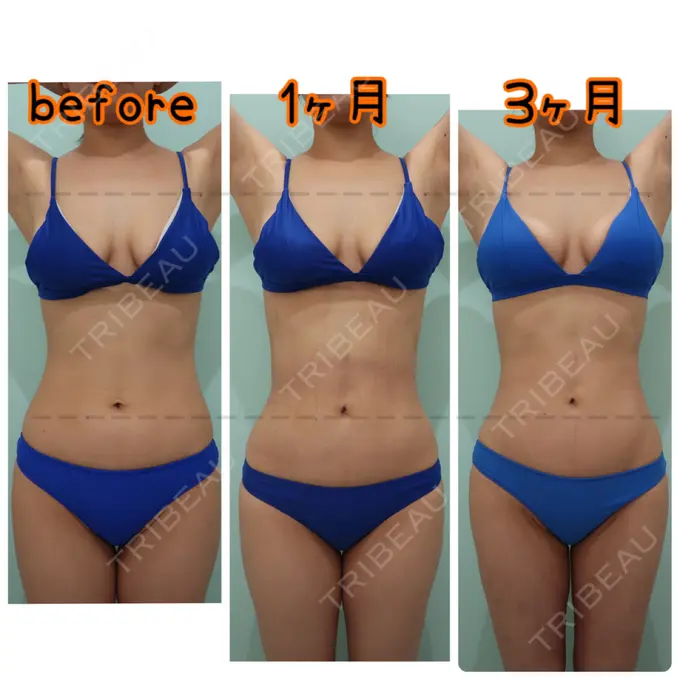 糸リフト / 脂肪吸引（顔） / 脂肪吸引（お腹） / 脂肪吸引（腰） / 脂肪吸引（背中） WOM CLINIC GINZA （ワム クリニック ギンザ） DAY 100 メイン用