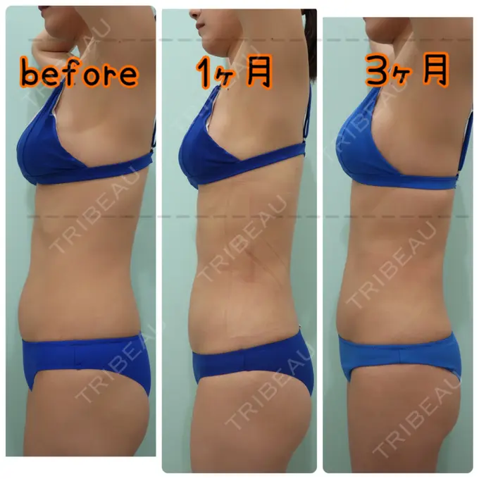 糸リフト / 脂肪吸引（顔） / 脂肪吸引（お腹） / 脂肪吸引（腰） / 脂肪吸引（背中） WOM CLINIC GINZA （ワム クリニック ギンザ） DAY 100 メイン用