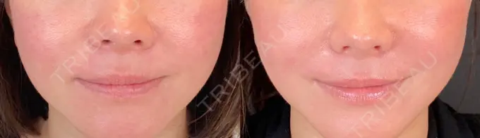 小鼻縮小（切開） / 眼瞼下垂（非切開） SOL CLINIC AFTER メイン用