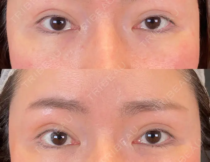 小鼻縮小（切開） / 眼瞼下垂（非切開） SOL CLINIC DAY 7 メイン用