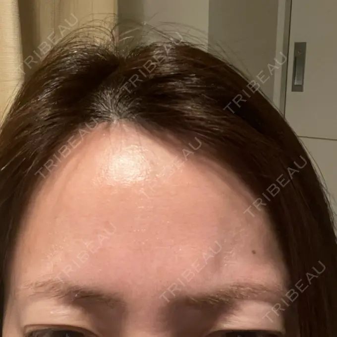 ボトックス（眉間） / ボトックス（額） X CLINIC 恵比寿院 DAY 3 メイン用