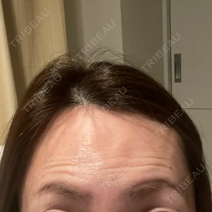 ボトックス（眉間） / ボトックス（額） X CLINIC 恵比寿院 DAY 3 メイン用