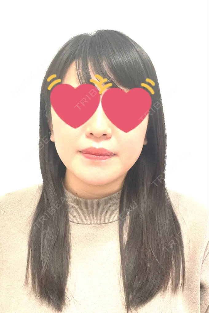 骨切り（あご） / セットバック カトレア歯科・美容クリニック AFTER メイン用