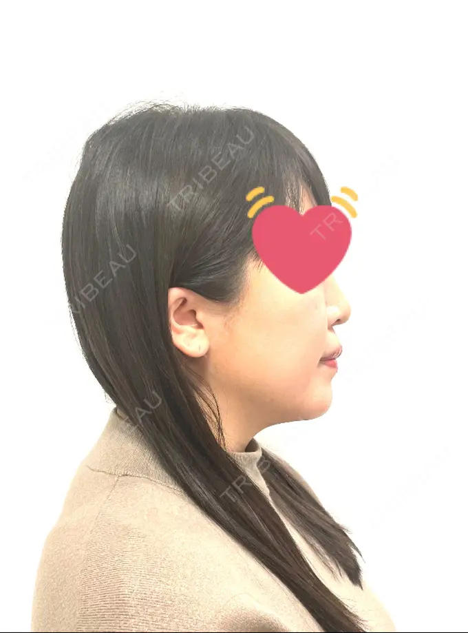 骨切り（あご） / セットバック カトレア歯科・美容クリニック DAY 190 メイン用