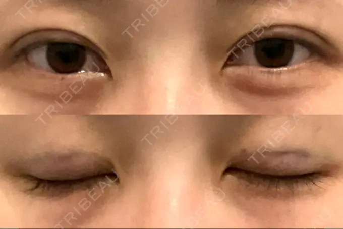 二重埋没 アリエル美容クリニック 郡山院 DAY 0 メイン用