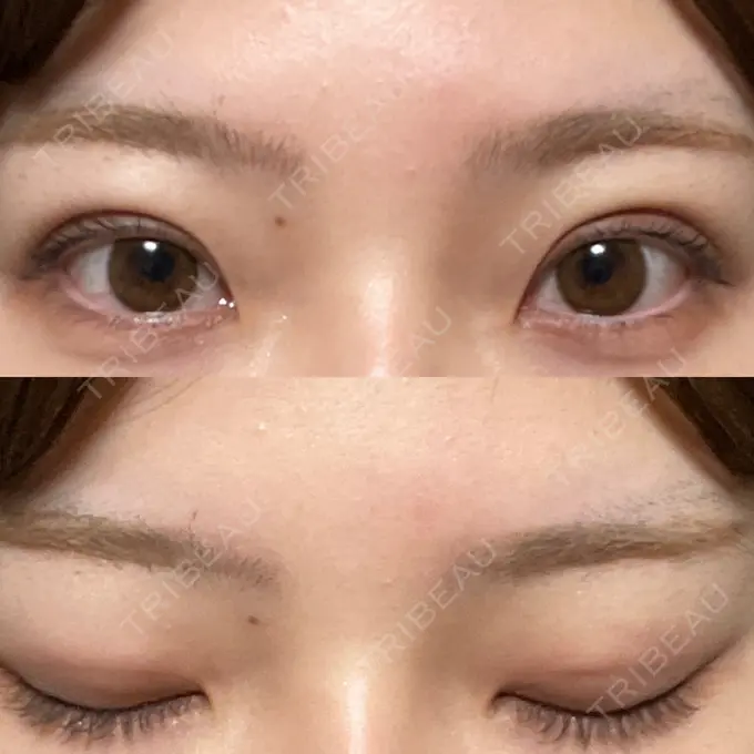 二重埋没 湘南美容クリニック 京都院 DAY 10 メイン用