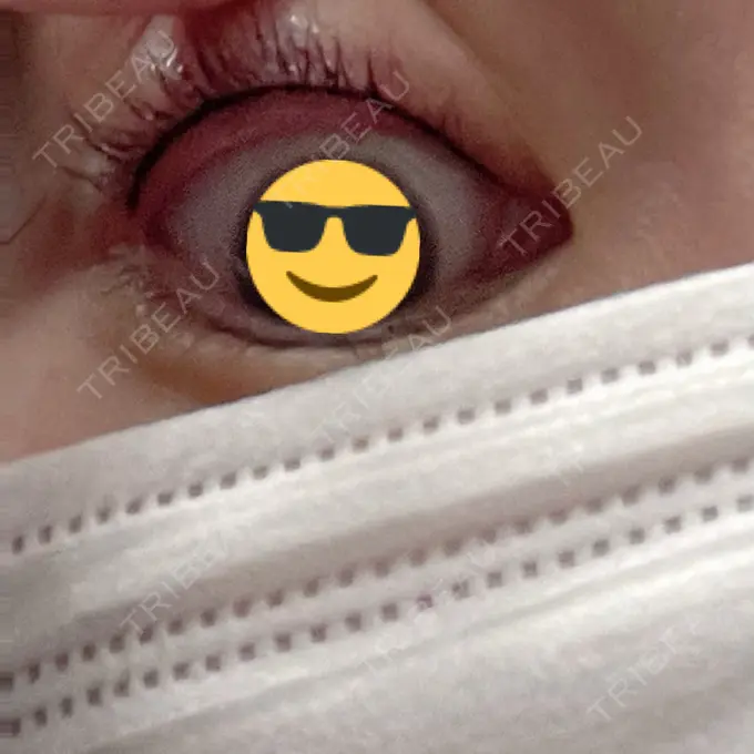 アートメイク（アイライン） 筋肉・美容クリニック DAY 0 メイン用