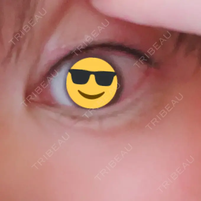 アートメイク（アイライン） 筋肉・美容クリニック DAY 27 メイン用