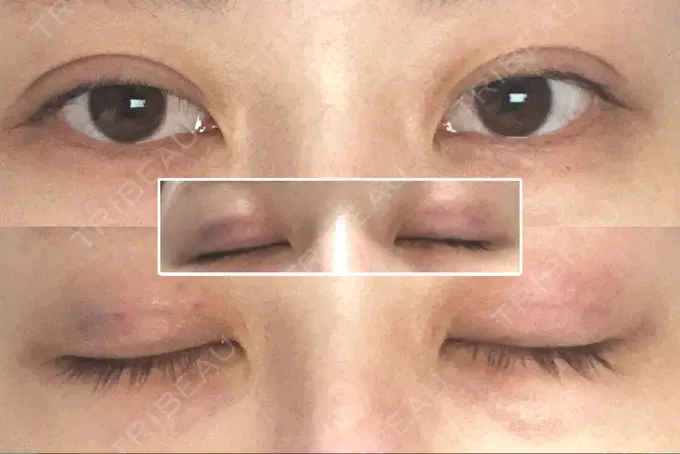 二重埋没 アリエル美容クリニック 郡山院 DAY 1 メイン用