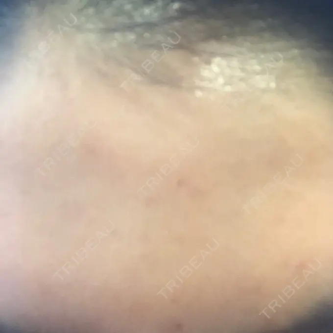 ダーマペン LIFIX BEAUTY CLINIC DAY 1 メイン用