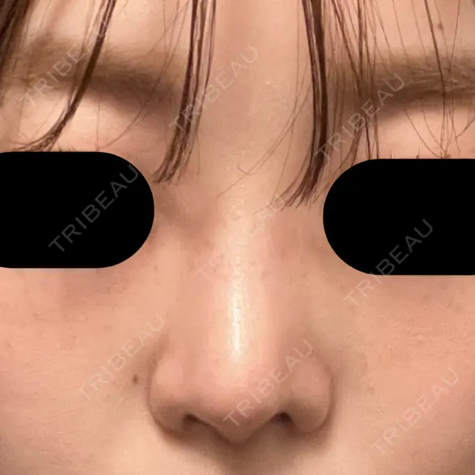 隆鼻術 / 鼻尖形成（切開） / 軟骨移植 / 鼻柱下降・鼻唇角形成（猫手術） グローバルビューティークリニック 大阪院 DAY 34 メイン用