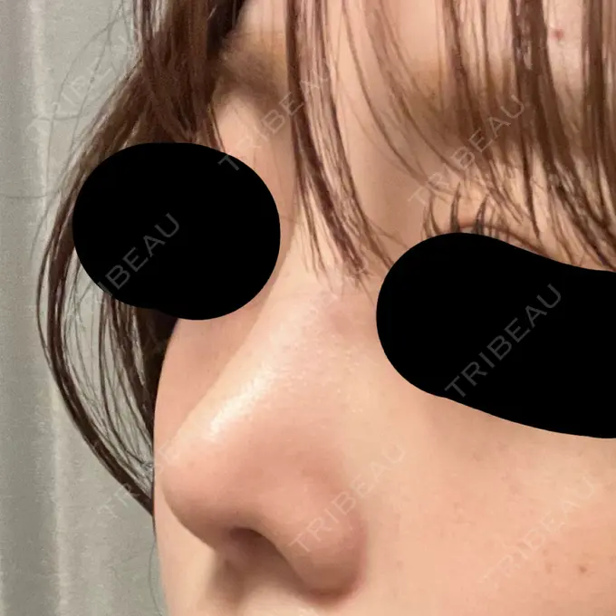 隆鼻術 / 鼻尖形成（切開） / 軟骨移植 / 鼻柱下降・鼻唇角形成（猫手術） グローバルビューティークリニック 大阪院 DAY 34 メイン用