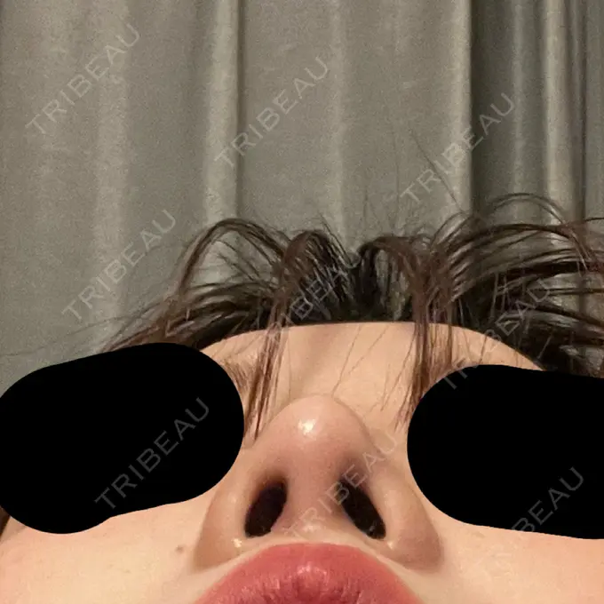 隆鼻術 / 鼻尖形成（切開） / 軟骨移植 / 鼻柱下降・鼻唇角形成（猫手術） グローバルビューティークリニック 大阪院 DAY 34 メイン用