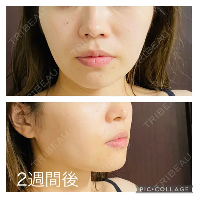 糸リフト アリエル美容クリニック 郡山院 AFTER メイン用