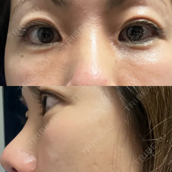 下まぶたたるみ取り セオリークリニック DAY 62 メイン用