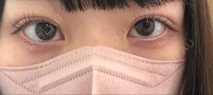 二重埋没 / 眼瞼下垂（非切開） WOM CLINIC GINZA （ワム クリニック ギンザ） AFTER メイン用