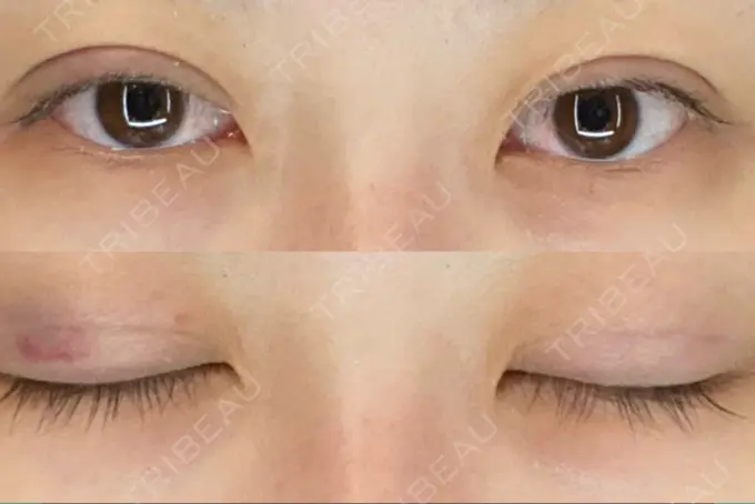 二重埋没 アリエル美容クリニック 郡山院 DAY 2 メイン用