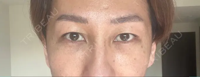 クマ治療 / シワ取りボトックス セオリークリニック DAY 3 メイン用