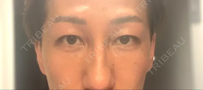 クマ治療 / シワ取りボトックス セオリークリニック AFTER メイン用