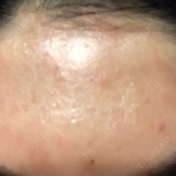 ダーマペン LIFIX BEAUTY CLINIC DAY 2 メイン用