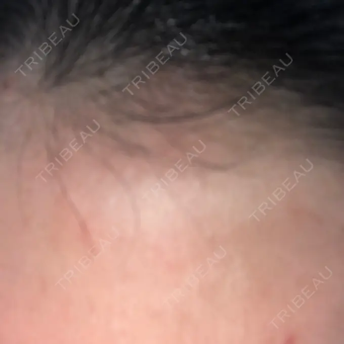 ダーマペン LIFIX BEAUTY CLINIC DAY 3 メイン用