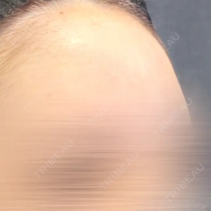 脂肪注入（額） / ヒアルロン酸注入（あご） X CLINIC 福岡天神院 DAY 7 メイン用