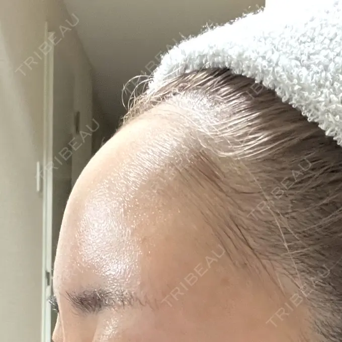 脂肪注入（額） / ヒアルロン酸注入（あご） X CLINIC 福岡天神院 AFTER メイン用