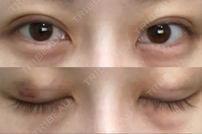 二重埋没 アリエル美容クリニック 郡山院 DAY 4 メイン用