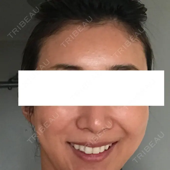 輪郭修正 / その他（輪郭） ニューセンス皮膚科クリニック DAY 7 メイン用