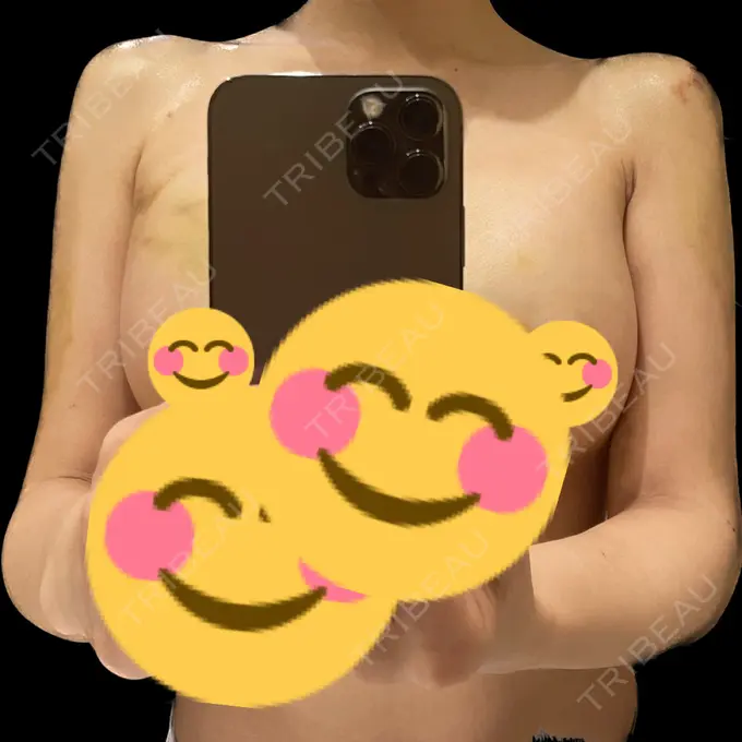 脂肪吸引（二の腕） / 脂肪吸引（脚） / 豊胸（脂肪注入） / 脂肪吸引（肩） Casa de GRACIA GINZA 【カーサデグラシアギンザ】 DAY 7 メイン用