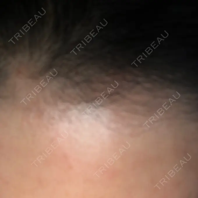 ダーマペン LIFIX BEAUTY CLINIC DAY 4 メイン用