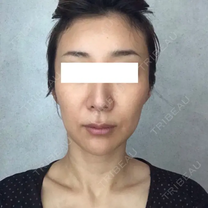 輪郭修正 / その他（輪郭） ニューセンス皮膚科クリニック DAY 6 メイン用