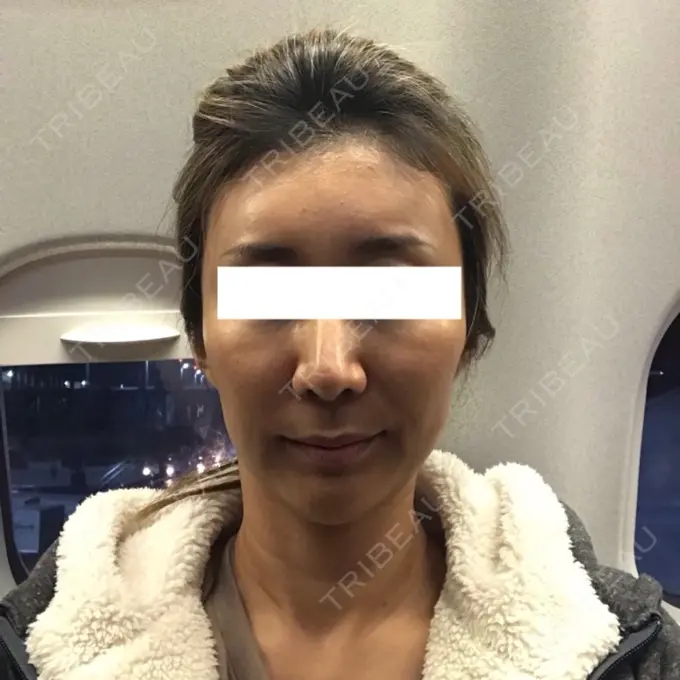 輪郭修正 / その他（輪郭） ニューセンス皮膚科クリニック DAY 14 メイン用