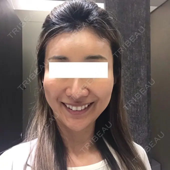 輪郭修正 / その他（輪郭） ニューセンス皮膚科クリニック DAY 21 メイン用