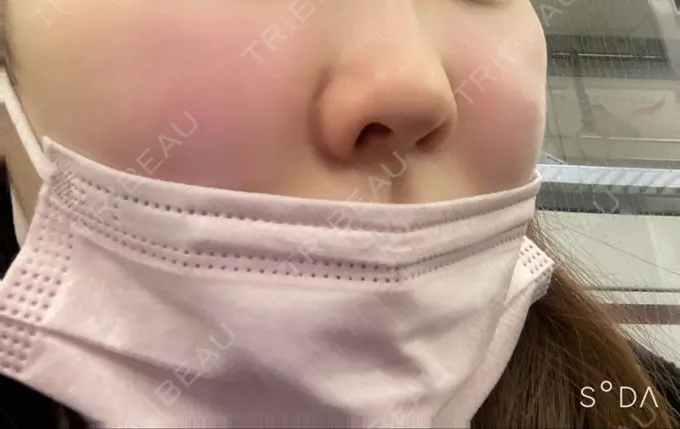 脂肪溶解注射（顔） アモーレクリニック 名古屋院 DAY 0 メイン用