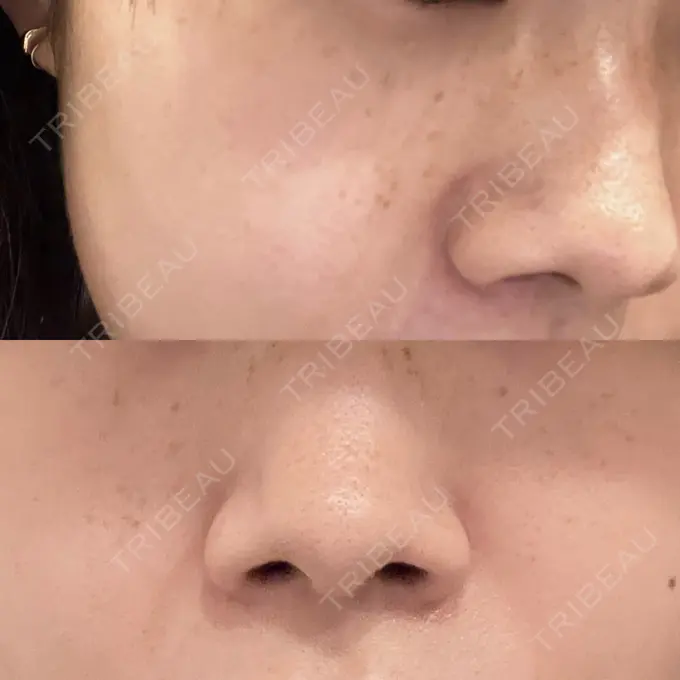 ピコレーザートーニング（美白・肝斑） / ピコフラクショナルレーザー（毛穴・ニキビ跡） ルラ美容クリニック 高田馬場院 DAY 0 メイン用