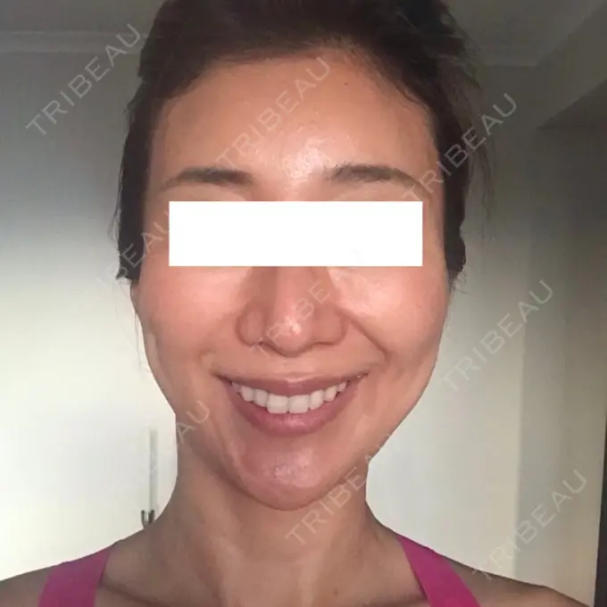 輪郭修正 / その他（輪郭） ニューセンス皮膚科クリニック DAY 26 メイン用