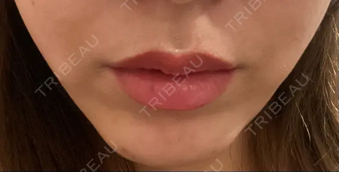 ボトックス（人中） veary clinic DAY 3 メイン用