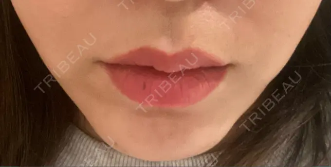 ボトックス（人中） veary clinic DAY 4 メイン用