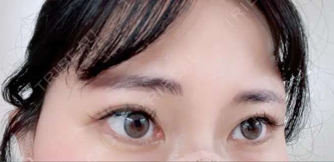 ヒアルロン酸注入（涙袋） 渋谷美容外科クリニック 渋谷院 AFTER メイン用