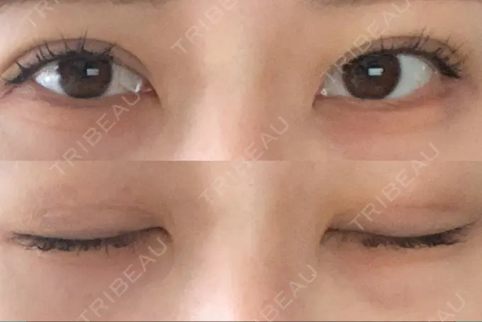 二重埋没 アリエル美容クリニック 郡山院 DAY 5 メイン用