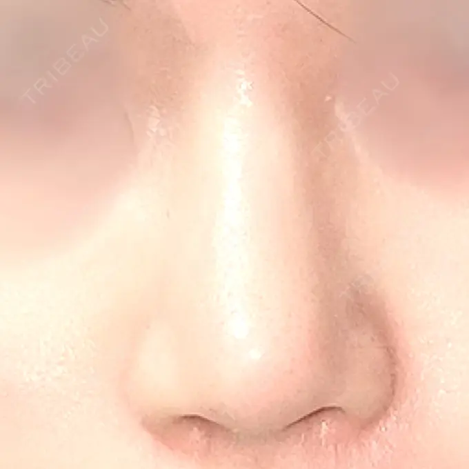 軟骨移植 / 骨切幅寄せ / 鼻中隔延長（非切開） エイト美容外科 DAY 123 メイン用