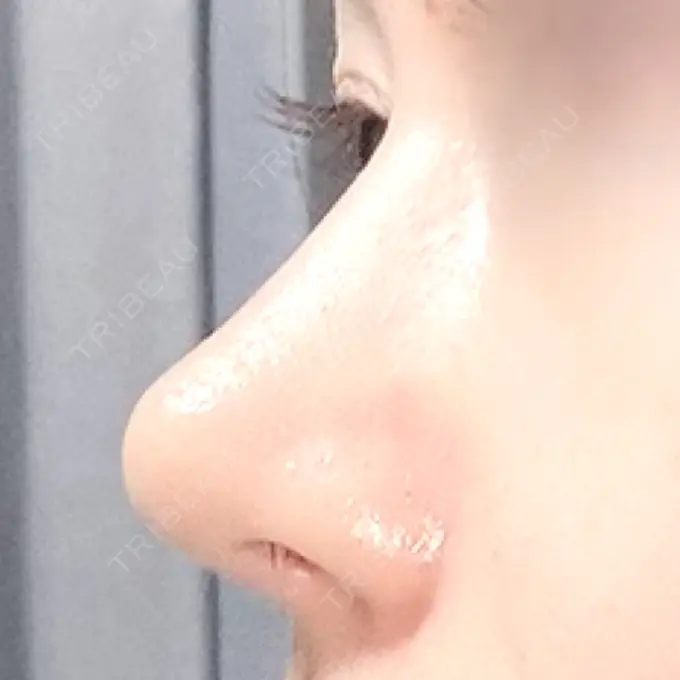 軟骨移植 / 骨切幅寄せ / 鼻中隔延長（非切開） エイト美容外科 DAY 123 メイン用