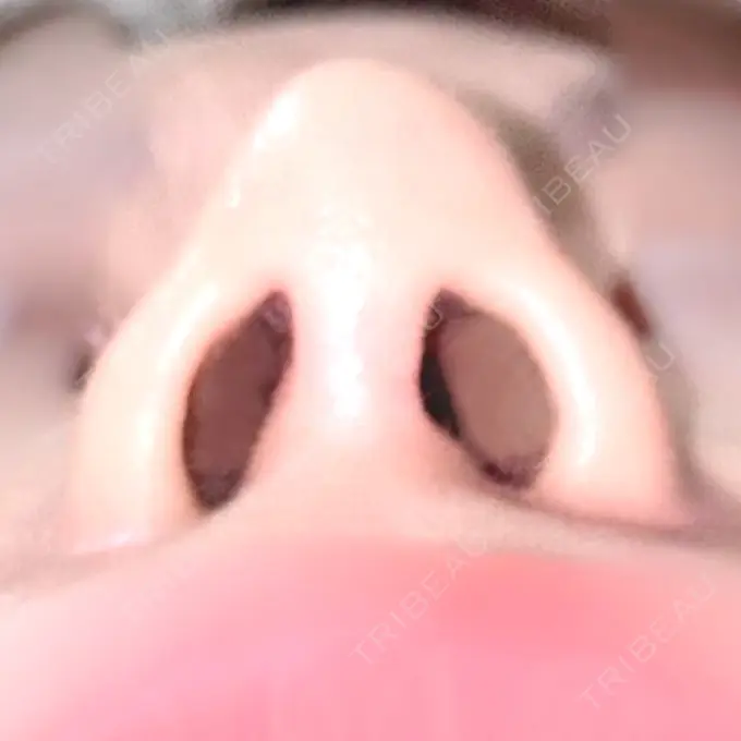 軟骨移植 / 骨切幅寄せ / 鼻中隔延長（非切開） エイト美容外科 DAY 123 メイン用