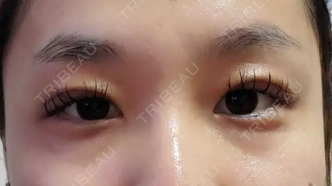 二重埋没 アリエル美容クリニック 郡山院 DAY 6 メイン用