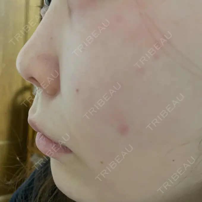 脂肪溶解注射（顔） アモーレクリニック 名古屋院 DAY 1 メイン用